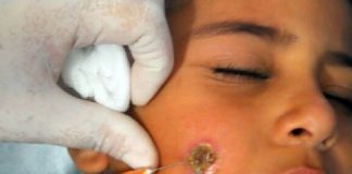 تسجيل انخفاض في الإصابة بداء اللشمانيا الجلدية خلال سنة 2019 مقارنة بسنة 2018