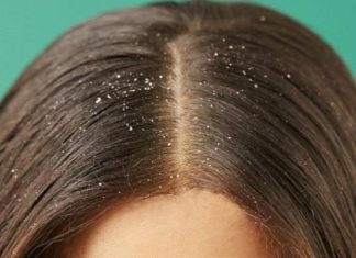 ظهور قشرة الشعر قد يرتبط بهذا المرض