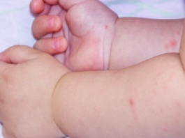 متلازمة الحمى القلاعية.. الدكتور الدوعاجي يُوضح بخصوص العدوى لدى الأطفال