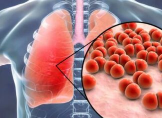 22 إصابة جديدة بالسلّ لكل 100 ألف ساكن في تونس